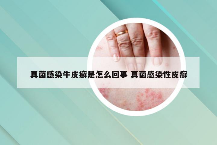 真菌感染牛皮癣是怎么回事 真菌感染性皮癣