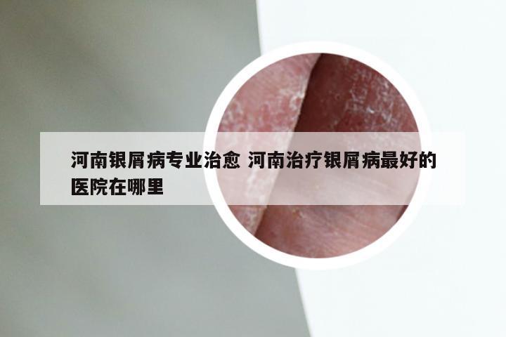 河南银屑病专业治愈 河南治疗银屑病最好的医院在哪里