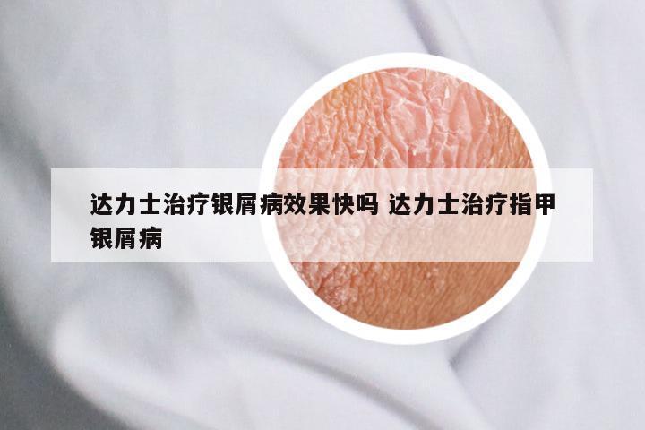 达力士治疗银屑病效果快吗 达力士治疗指甲银屑病