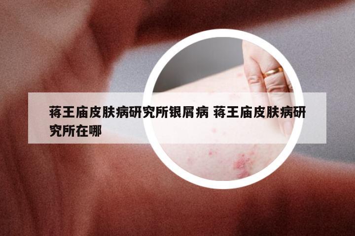 蒋王庙皮肤病研究所银屑病 蒋王庙皮肤病研究所在哪