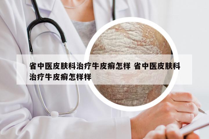 省中医皮肤科治疗牛皮癣怎样 省中医皮肤科治疗牛皮癣怎样样
