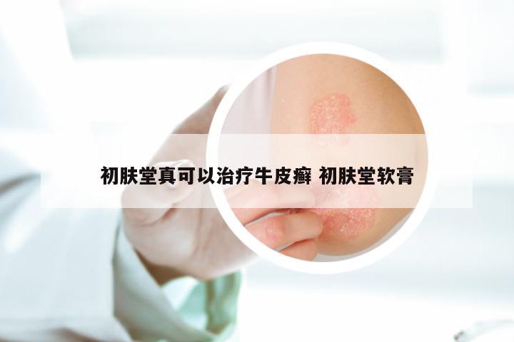 初肤堂真可以治疗牛皮癣 初肤堂软膏