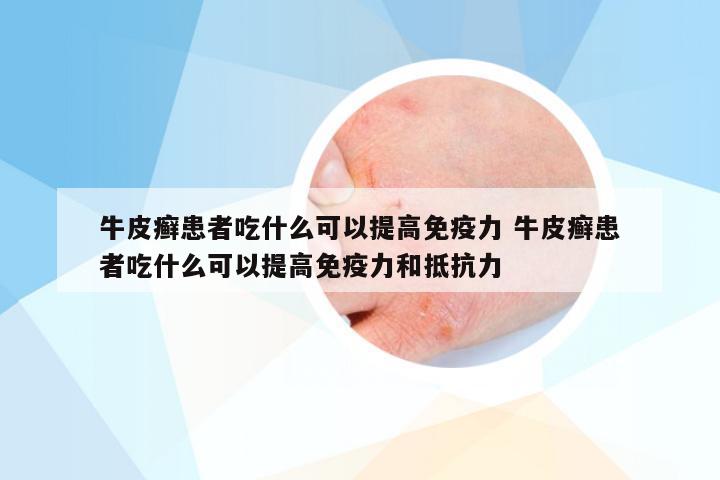 牛皮癣患者吃什么可以提高免疫力 牛皮癣患者吃什么可以提高免疫力和抵抗力