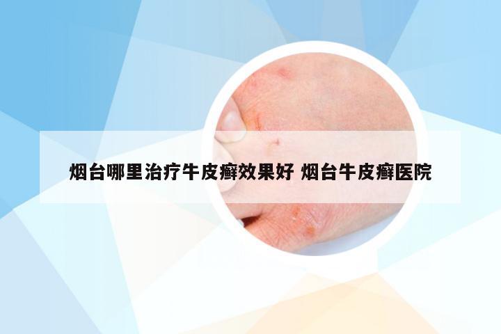 烟台哪里治疗牛皮癣效果好 烟台牛皮癣医院