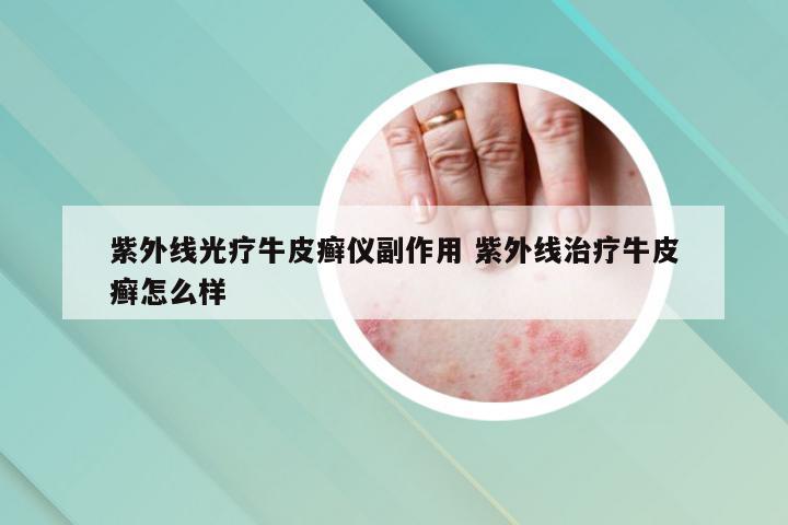 紫外线光疗牛皮癣仪副作用 紫外线治疗牛皮癣怎么样