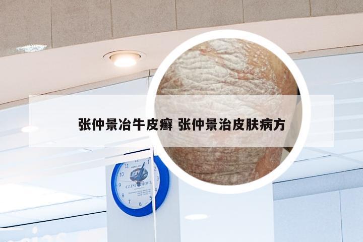 张仲景冶牛皮癣 张仲景治皮肤病方