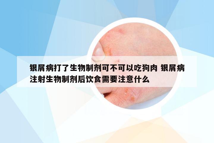 银屑病打了生物制剂可不可以吃狗肉 银屑病注射生物制剂后饮食需要注意什么