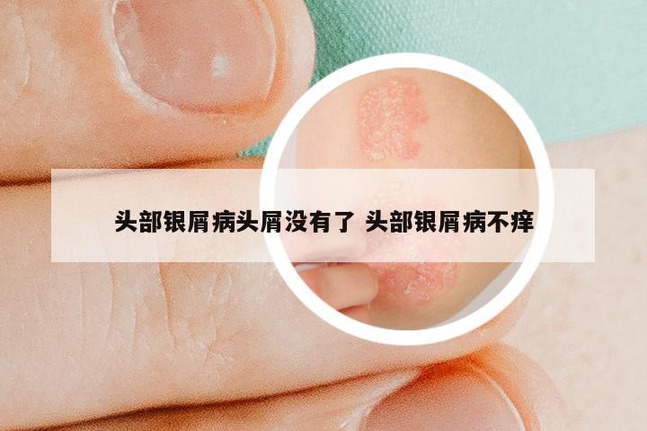 头部银屑病头屑没有了 头部银屑病不痒
