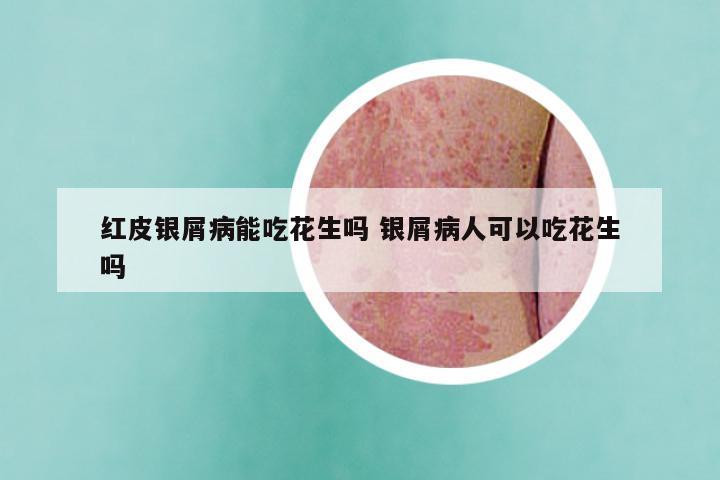 红皮银屑病能吃花生吗 银屑病人可以吃花生吗