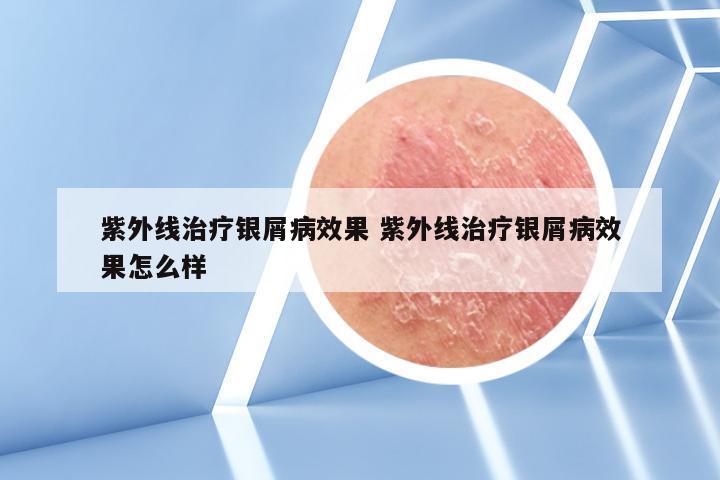紫外线治疗银屑病效果 紫外线治疗银屑病效果怎么样