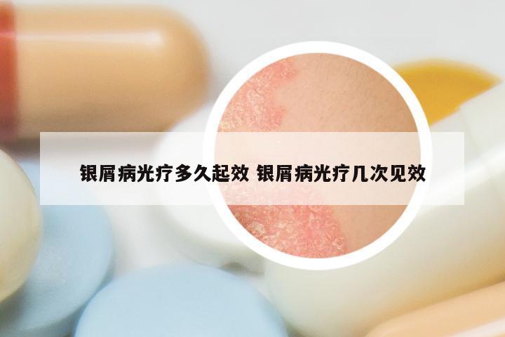 银屑病光疗多久起效 银屑病光疗几次见效
