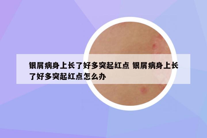 银屑病身上长了好多突起红点 银屑病身上长了好多突起红点怎么办