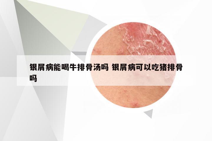 银屑病能喝牛排骨汤吗 银屑病可以吃猪排骨吗