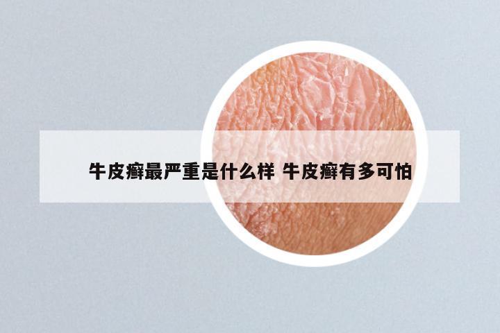 牛皮癣最严重是什么样 牛皮癣有多可怕