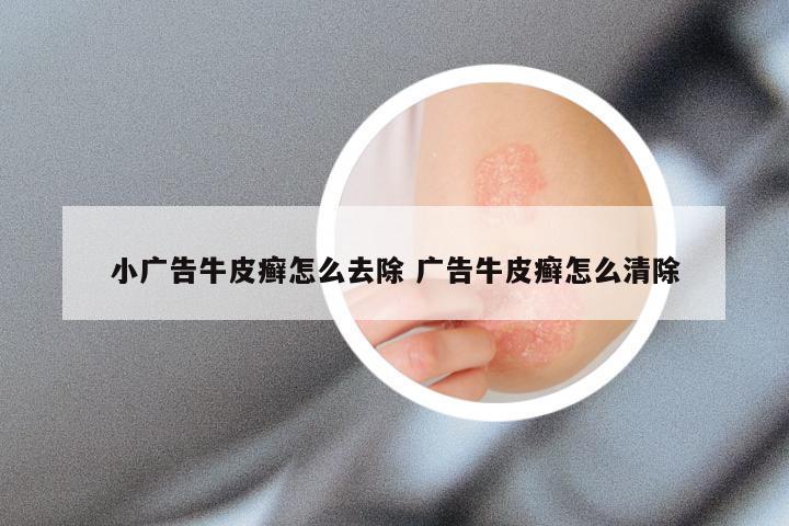 小广告牛皮癣怎么去除 广告牛皮癣怎么清除