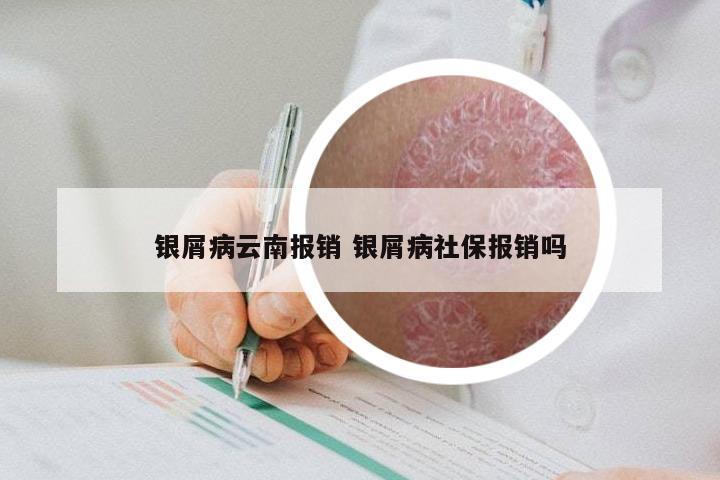 银屑病云南报销 银屑病社保报销吗