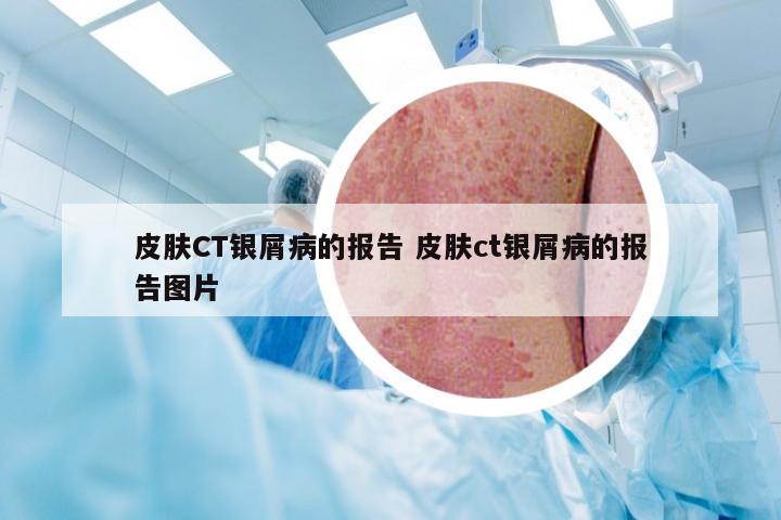 皮肤CT银屑病的报告 皮肤ct银屑病的报告图片