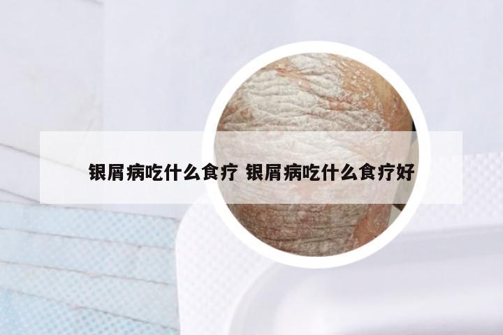 银屑病吃什么食疗 银屑病吃什么食疗好