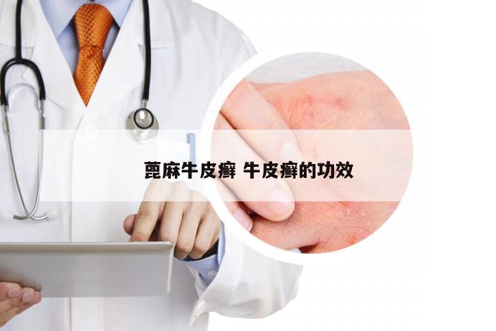 蓖麻牛皮癣 牛皮癣的功效