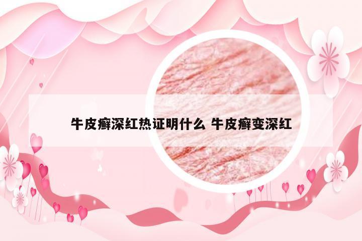 牛皮癣深红热证明什么 牛皮癣变深红