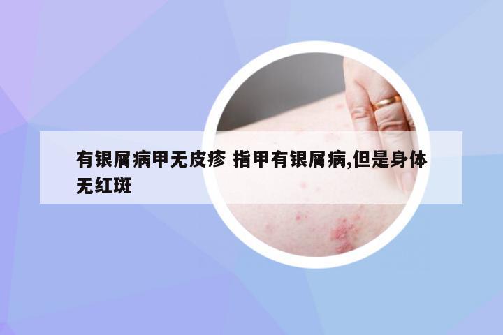 有银屑病甲无皮疹 指甲有银屑病,但是身体无红斑