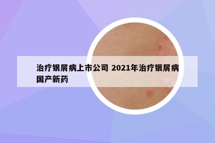 治疗银屑病上市公司 2021年治疗银屑病国产新药