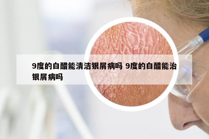 9度的白醋能清洁银屑病吗 9度的白醋能治银屑病吗