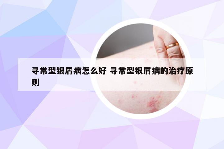 寻常型银屑病怎么好 寻常型银屑病的治疗原则