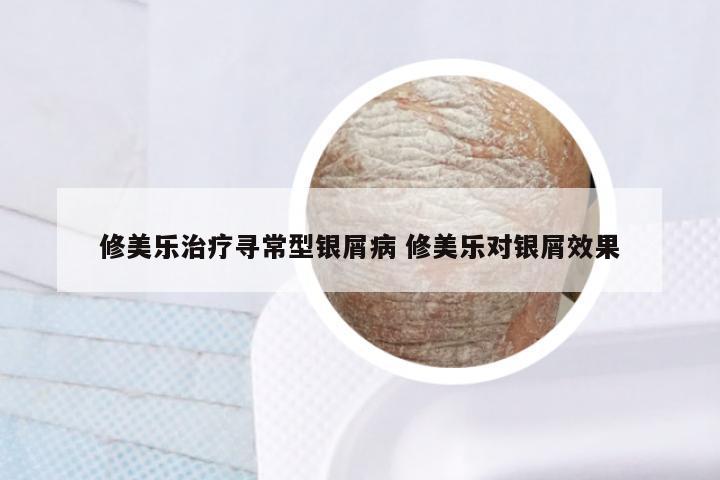 修美乐治疗寻常型银屑病 修美乐对银屑效果