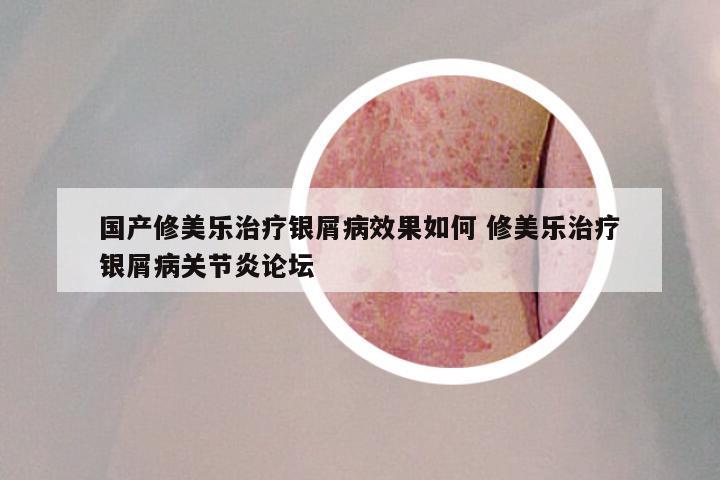 国产修美乐治疗银屑病效果如何 修美乐治疗银屑病关节炎论坛