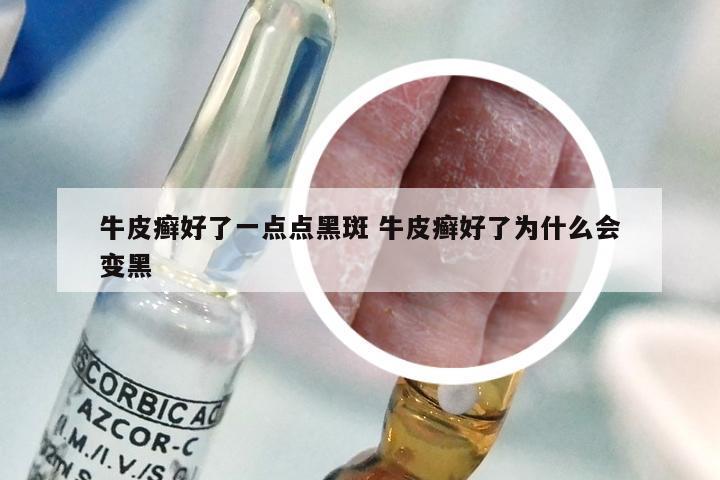 牛皮癣好了一点点黑斑 牛皮癣好了为什么会变黑