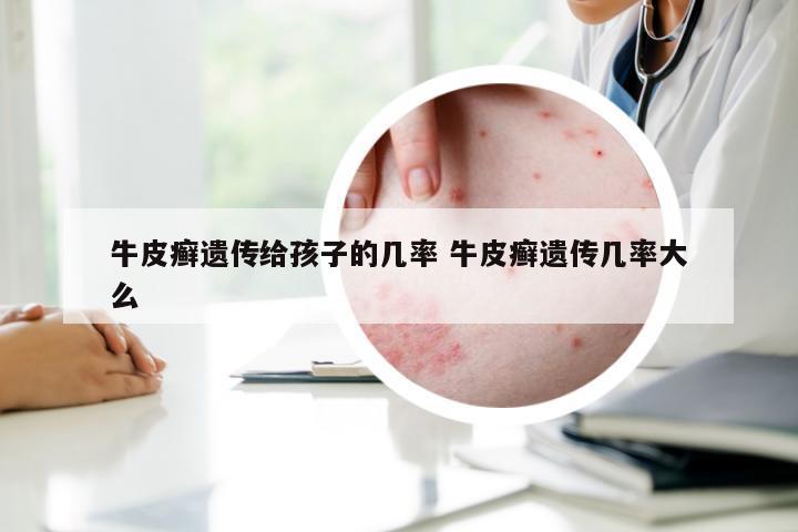 牛皮癣遗传给孩子的几率 牛皮癣遗传几率大么