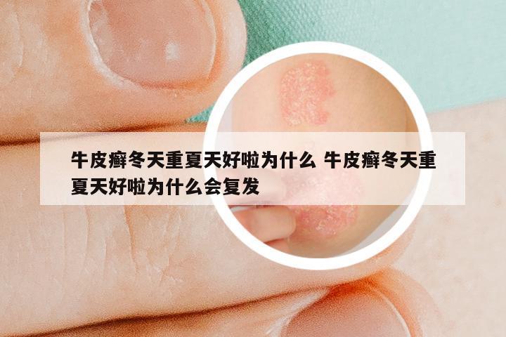 牛皮癣冬天重夏天好啦为什么 牛皮癣冬天重夏天好啦为什么会复发