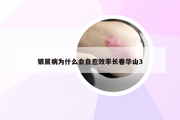 银屑病为什么会自愈效率长春华山3