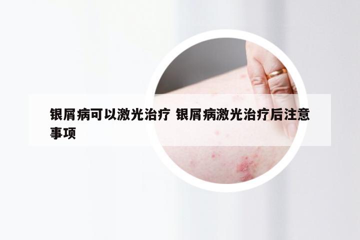 银屑病可以激光治疗 银屑病激光治疗后注意事项