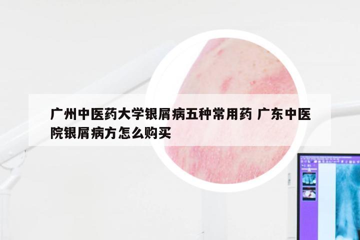 广州中医药大学银屑病五种常用药 广东中医院银屑病方怎么购买