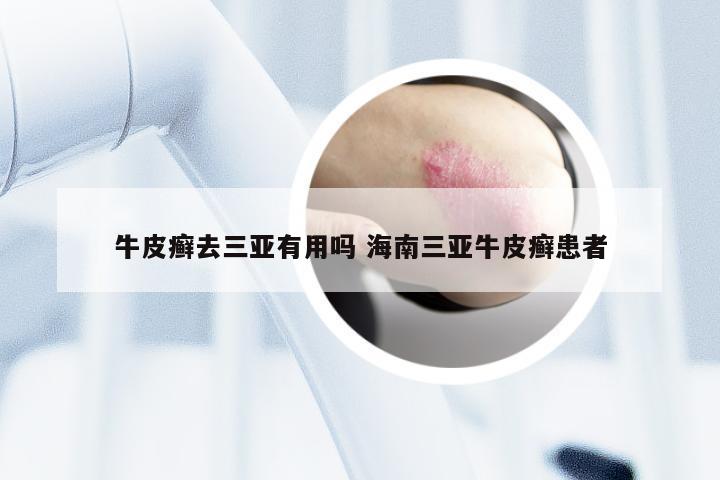牛皮癣去三亚有用吗 海南三亚牛皮癣患者