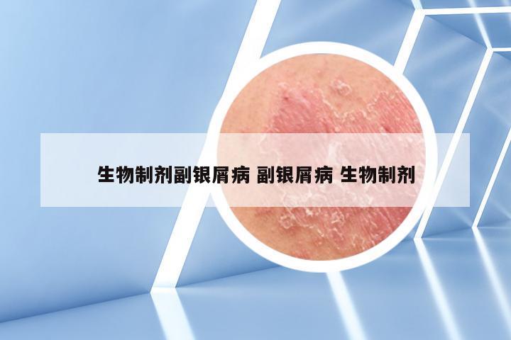 生物制剂副银屑病 副银屑病 生物制剂