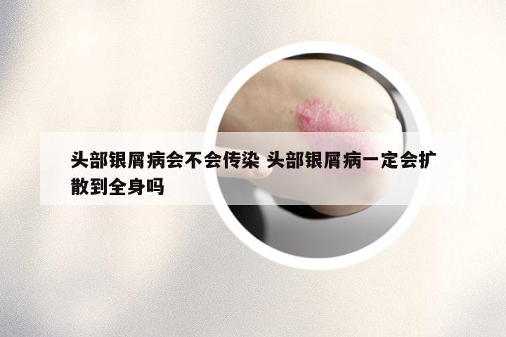 头部银屑病会不会传染 头部银屑病一定会扩散到全身吗