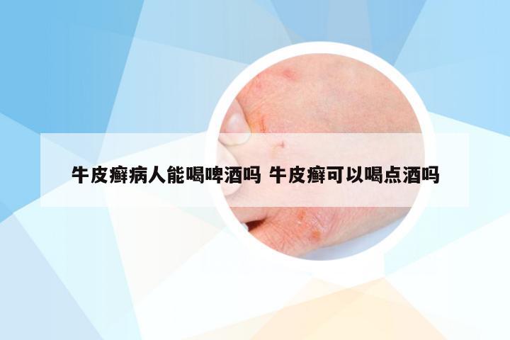 牛皮癣病人能喝啤酒吗 牛皮癣可以喝点酒吗