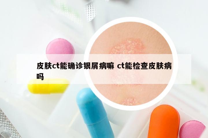 皮肤ct能确诊银屑病嘛 ct能检查皮肤病吗