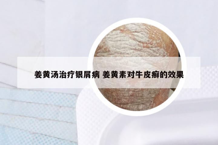 姜黄汤治疗银屑病 姜黄素对牛皮癣的效果