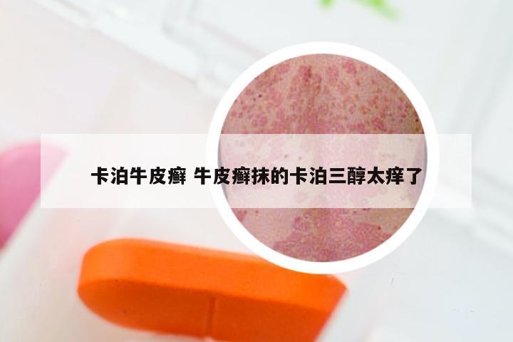 卡泊牛皮癣 牛皮癣抹的卡泊三醇太痒了