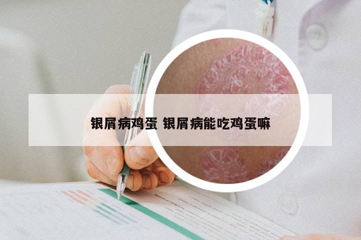 银屑病鸡蛋 银屑病能吃鸡蛋嘛
