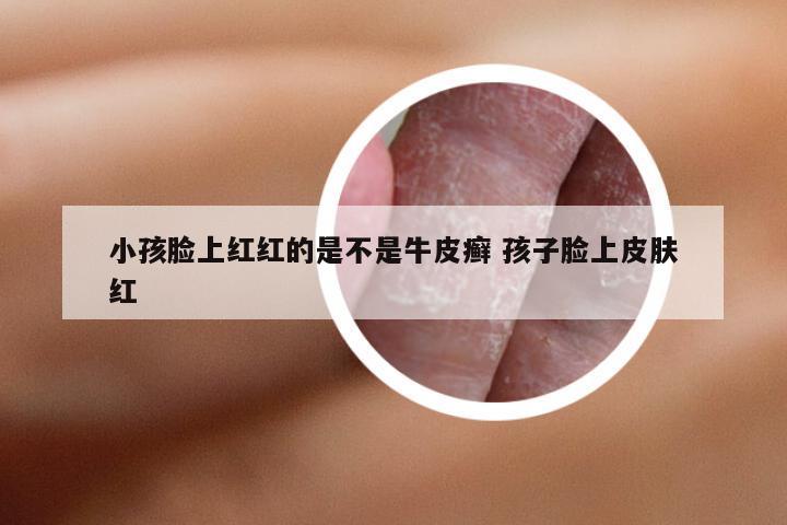小孩脸上红红的是不是牛皮癣 孩子脸上皮肤红