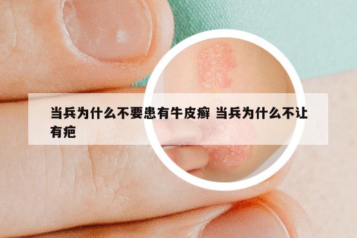 当兵为什么不要患有牛皮癣 当兵为什么不让有疤
