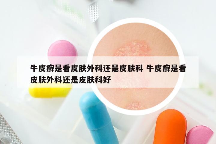 牛皮癣是看皮肤外科还是皮肤科 牛皮癣是看皮肤外科还是皮肤科好