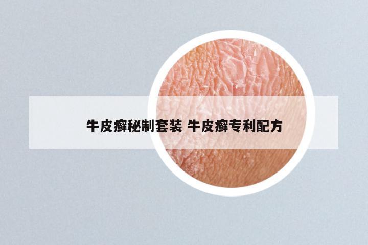 牛皮癣秘制套装 牛皮癣专利配方