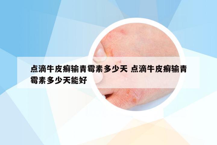 点滴牛皮癣输青霉素多少天 点滴牛皮癣输青霉素多少天能好