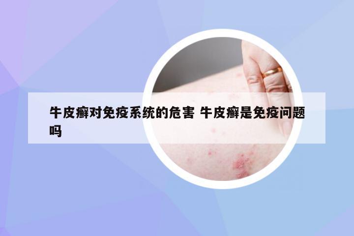 牛皮癣对免疫系统的危害 牛皮癣是免疫问题吗